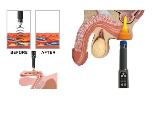Clinic Use Dual Channel Acoustic ESWT Therapy Machine For Full Body Massage ED Treatment