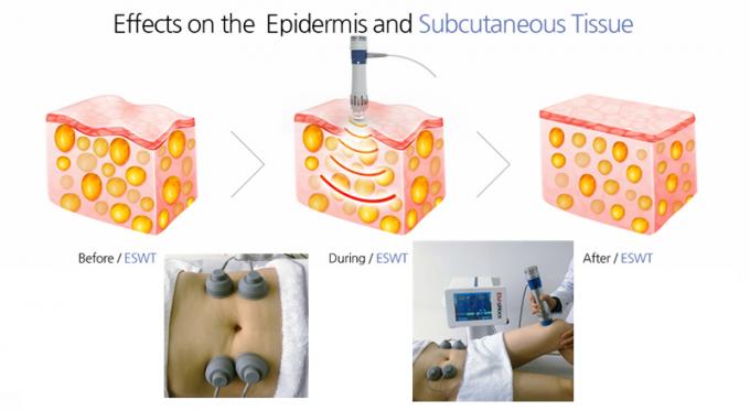 White Electrical Muscle Stimulation Machine Low Intensity Extracorporeal Shockwave Therapy Type 2